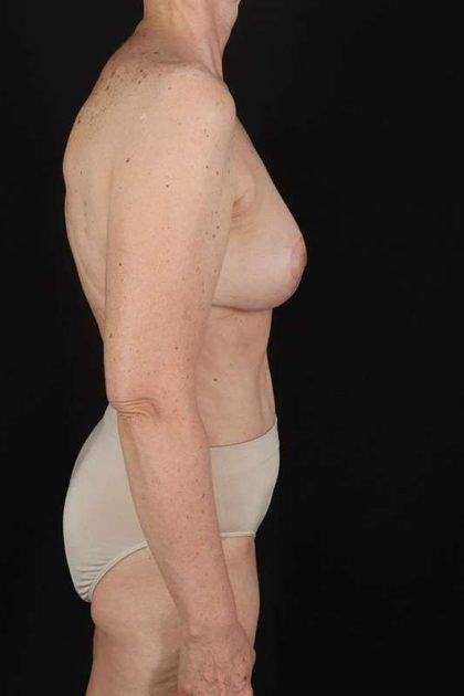All Me Augmentation Before & After Patient #1197