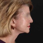 All Me Facelift Before & After Patient #240