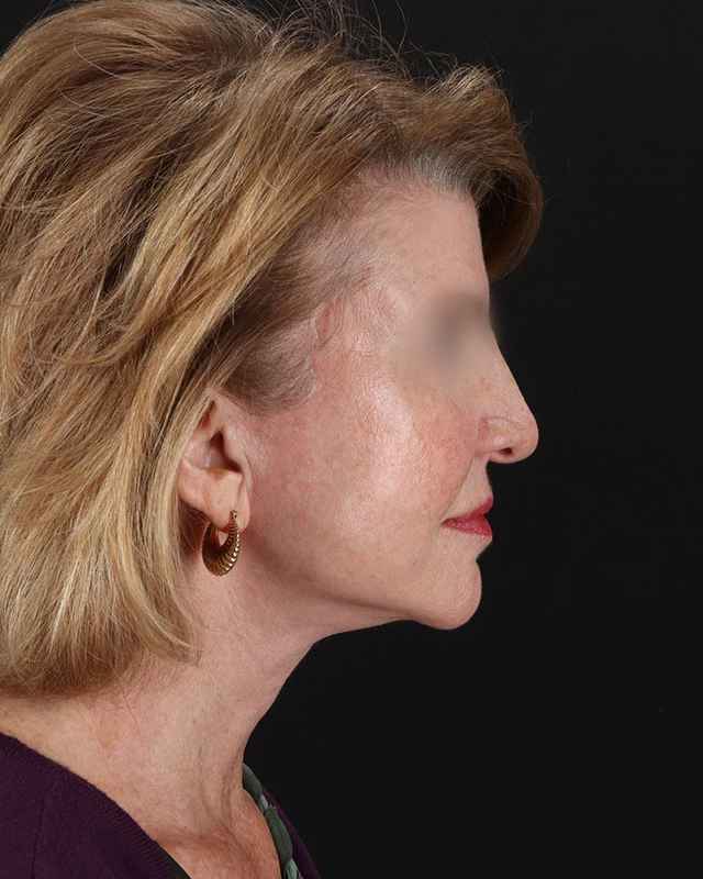 All Me Facelift Before & After Patient #240