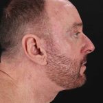 All Me Facelift Before & After Patient #343