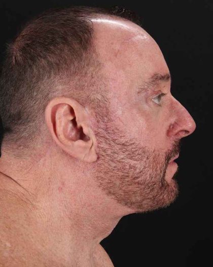 All Me Facelift Before & After Patient #343