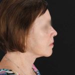 All Me Facelift Before & After Patient #354