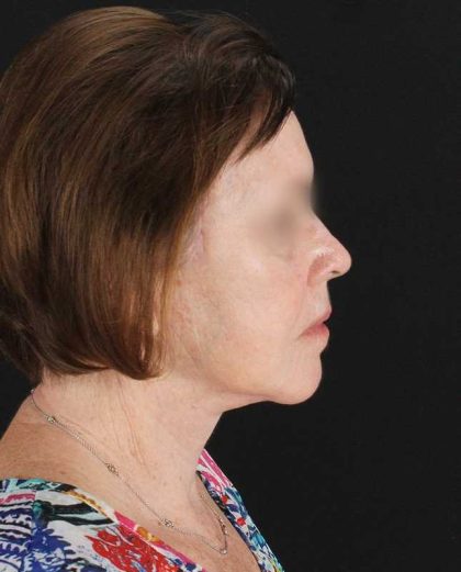 All Me Facelift Before & After Patient #354