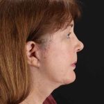 All Me Facelift Before & After Patient #366