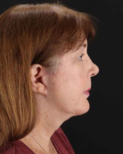 All Me Facelift Before & After Patient #366