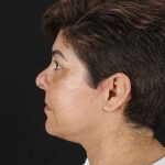 All Me Facelift Before & After Patient #373