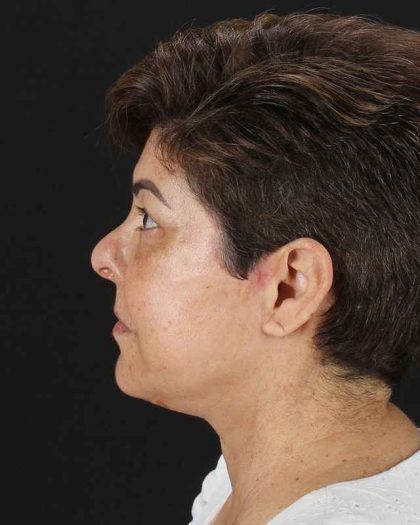 All Me Facelift Before & After Patient #373
