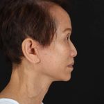 All Me Facelift Before & After Patient #395