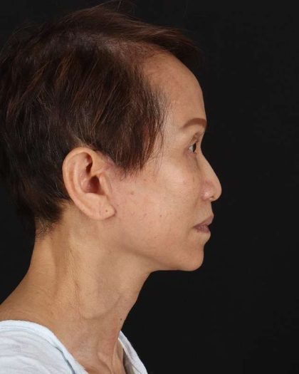 All Me Facelift Before & After Patient #395