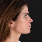 All Me Facelift Before & After Patient #406