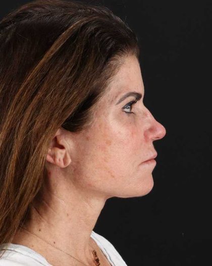 All Me Facelift Before & After Patient #406