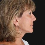 All Me Facelift Before & After Patient #418
