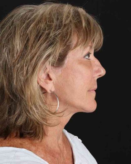All Me Facelift Before & After Patient #418