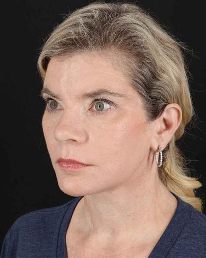 All Me Facelift Before & After Patient #428