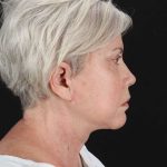 All Me Facelift Before & After Patient #439