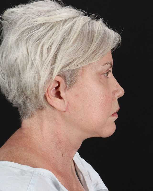 All Me Facelift Before & After Patient #439