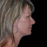 All Me Facelift Before & After Patient #252