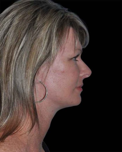 All Me Facelift Before & After Patient #252