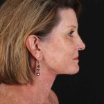 All Me Facelift Before & After Patient #461