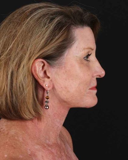All Me Facelift Before & After Patient #461