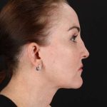 All Me Facelift Before & After Patient #472