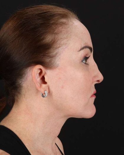 All Me Facelift Before & After Patient #472