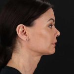 All Me Facelift Before & After Patient #483