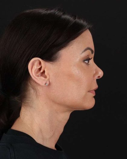 All Me Facelift Before & After Patient #483
