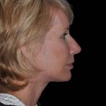 All Me Facelift Before & After Patient #263