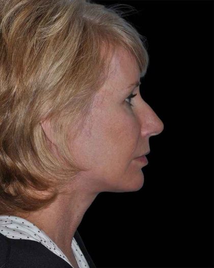 All Me Facelift Before & After Patient #263