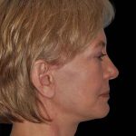 All Me Facelift Before & After Patient #274