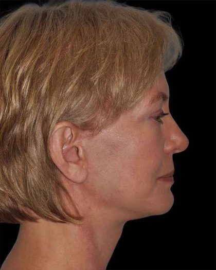 All Me Facelift Before & After Patient #274