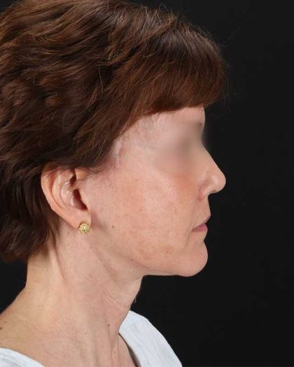 All Me Facelift Before & After Patient #229