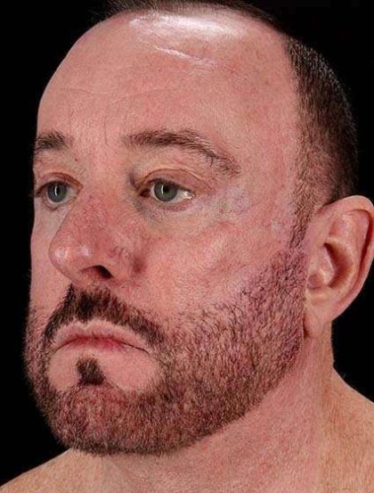 All Me Facelift Before & After Patient #728