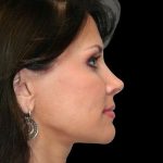All Me Facelift Before & After Patient #286