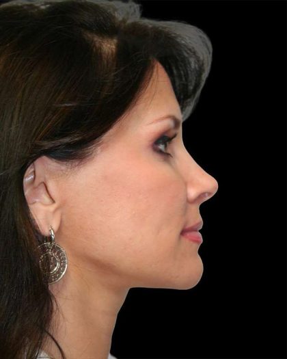 All Me Facelift Before & After Patient #286