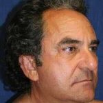 All Me Facelift Before & After Patient #742
