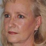All Me Facelift Before & After Patient #763