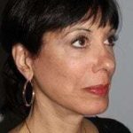 All Me Facelift Before & After Patient #770