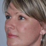 All Me Facelift Before & After Patient #781