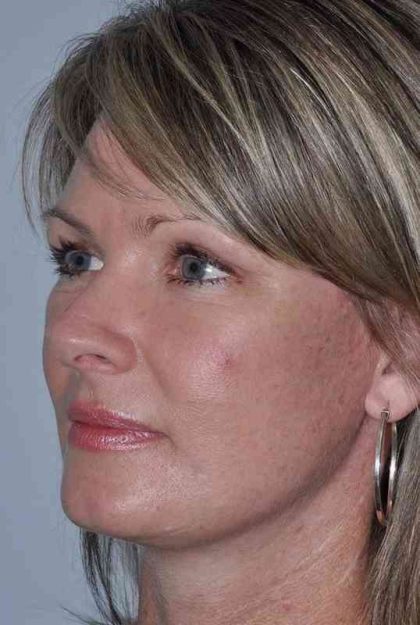All Me Facelift Before & After Patient #781