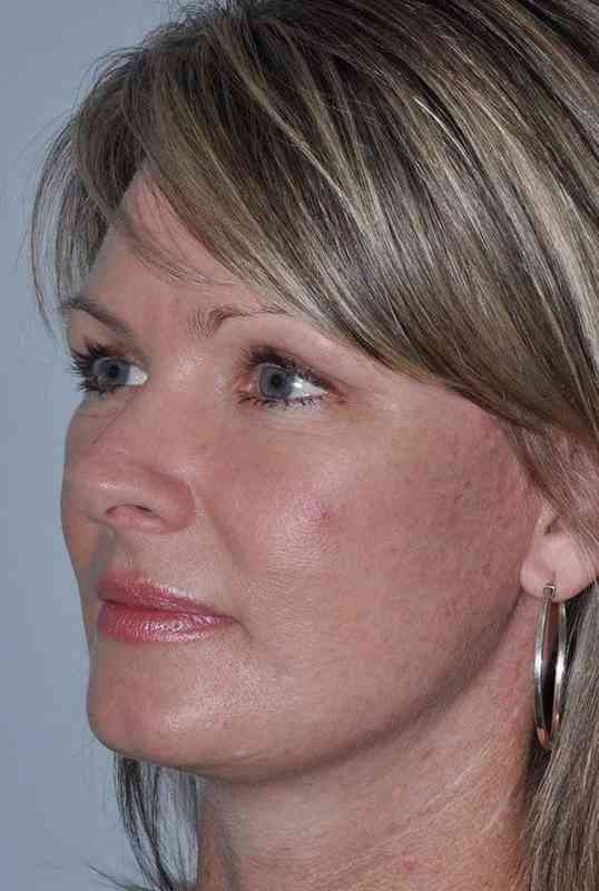 All Me Facelift Before & After Patient #781