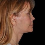 All Me Facelift Before & After Patient #297