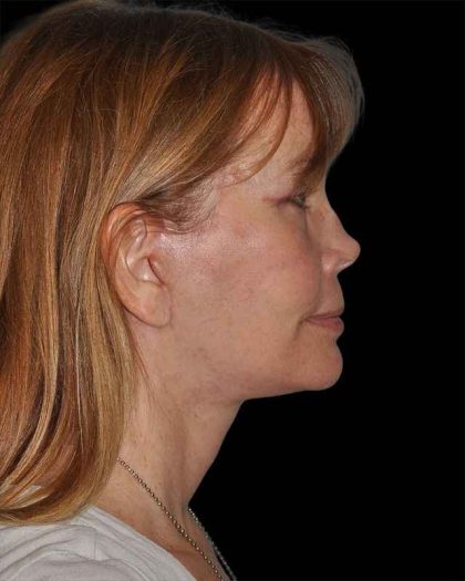 All Me Facelift Before & After Patient #297