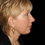 All Me Facelift Before & After Patient #308