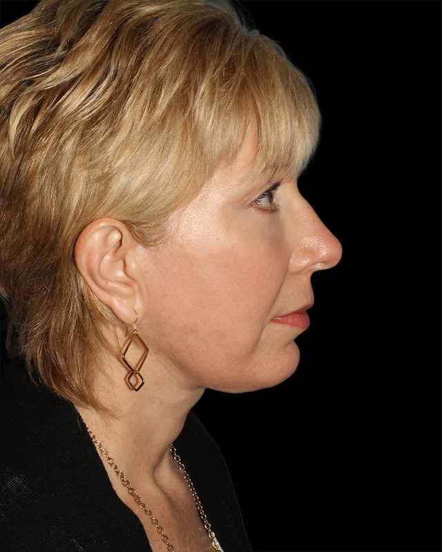 All Me Facelift Before & After Patient #308