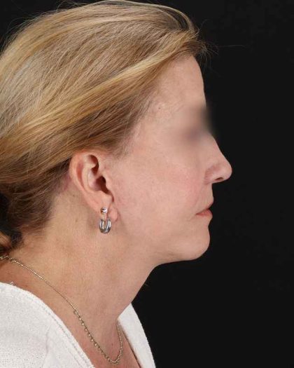 All Me Facelift Before & After Patient #320