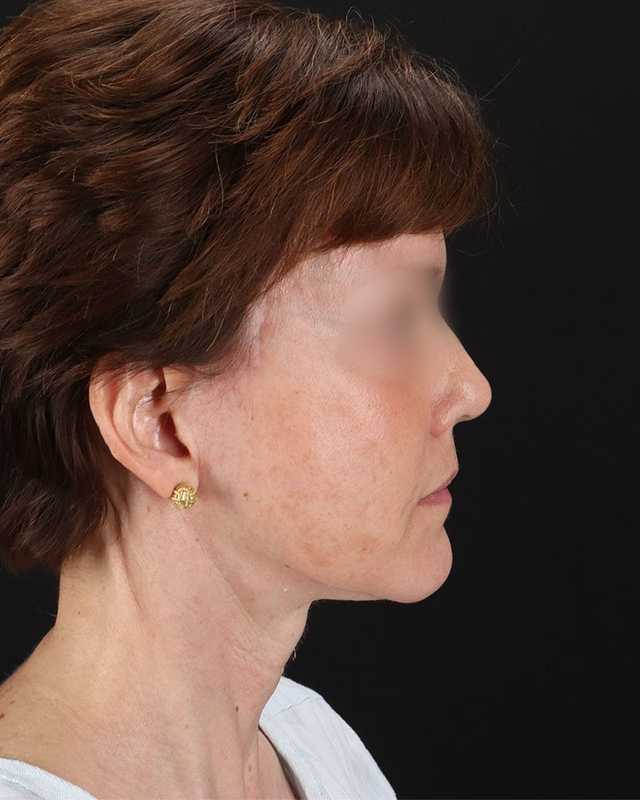 All Me Facelift Before & After Patient #229