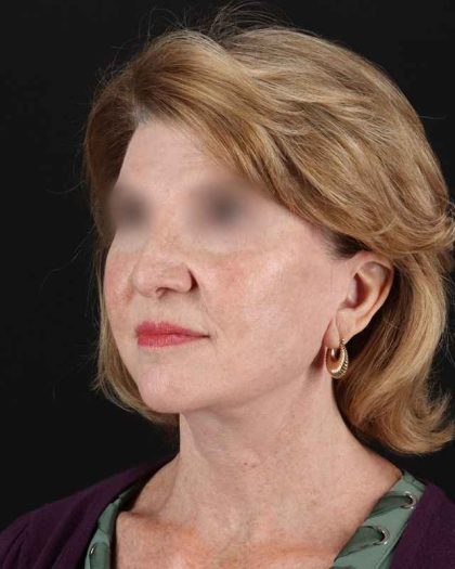 All Me Facelift Before & After Patient #240