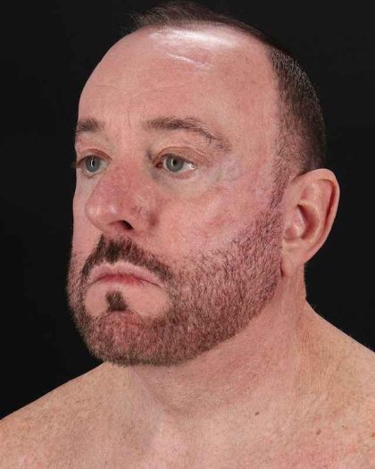 All Me Facelift Before & After Patient #343